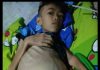 Siswa SDN 2 Talagawangi Pakenjeng Menderita Busung Lapar, Kian Hari Perutnya Kian Membesar